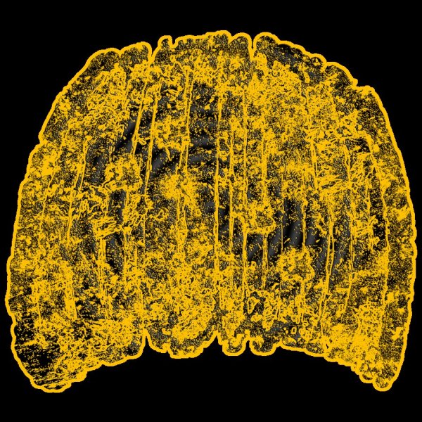 Glaucoma - Passagers D'affaires